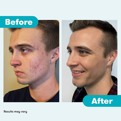 Proactiv Acne Medication Repairing Treatment Step 3 Repair 2 Oz