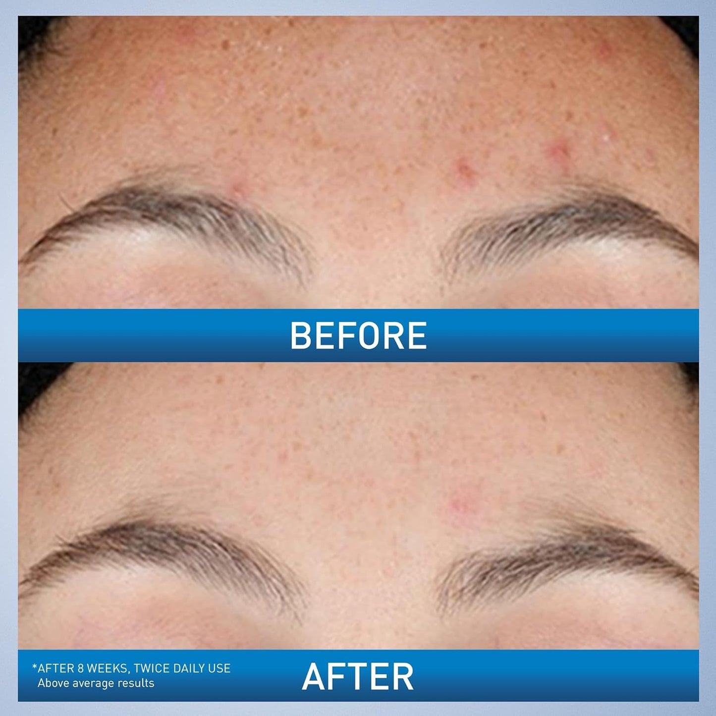CeraVe Resurfacing Retinol Serum For Post Acne Marks 1 oz / 30 ml