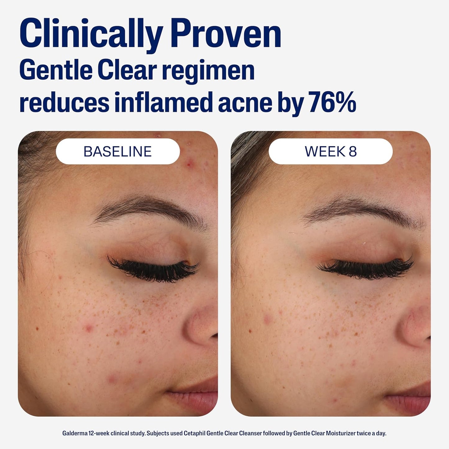 Cetaphil Face Moisturizer, Gentle Clear Mattifying Acne Moisturizer with 0.5% Salicylic Acid, Hydrates and Treats Sensitive Acne Prone Skin, Skin Care for Sensitive Skin, 3Oz