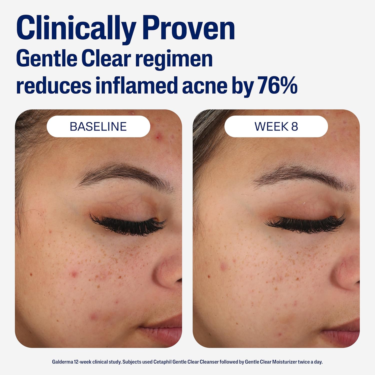 Cetaphil Face Moisturizer, Gentle Clear Mattifying Acne Moisturizer with 0.5% Salicylic Acid, Hydrates and Treats Sensitive Acne Prone Skin, Skin Care for Sensitive Skin, 3Oz